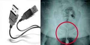 Ngilu! Karena Penasaran, Kabel USB Tersangkut di Alat Vital