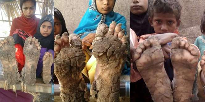 4 Bersaudara Derita Penyakit Aneh, Kaki dan Tangan Membatu