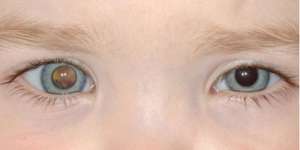 Selain Leukimia, Ini Kanker yang Juga Banyak Menyerang Anak