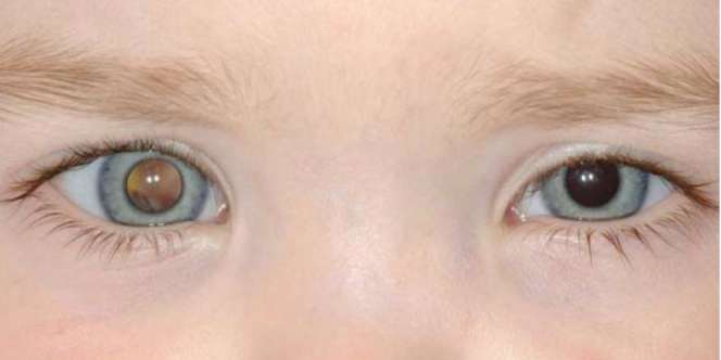 Selain Leukimia, Ini Kanker yang Juga Banyak Menyerang Anak