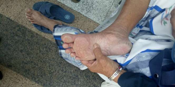 Tak Pakai Sandal, Kaki Jemaah Haji Melepuh