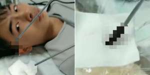 10 Hari Mimisan, Saat Dicek Isi Hidungnya Mengejutkan
