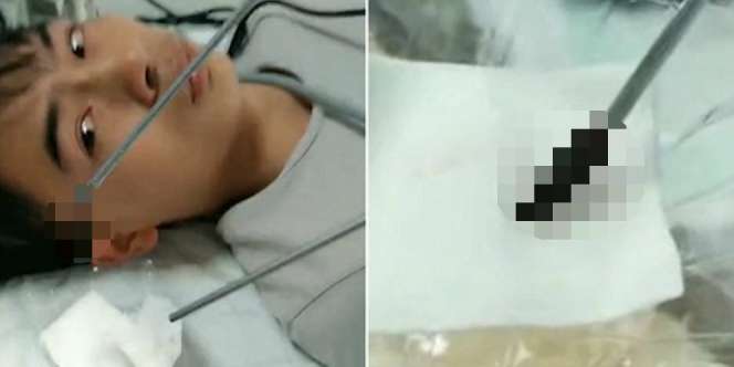 10 Hari Mimisan, Saat Dicek Isi Hidungnya Mengejutkan