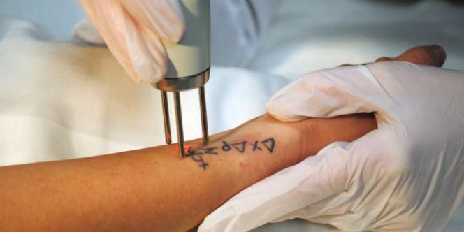 Prosedur Menghilangkan Tato Menggunakan Laser