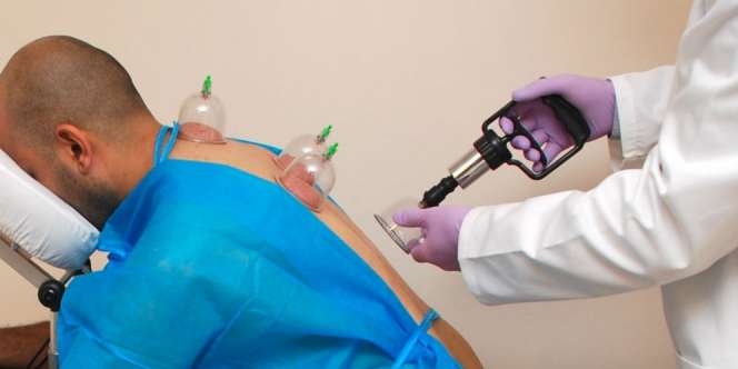 Darah Akibat Bekam Batalkan Wudhu?