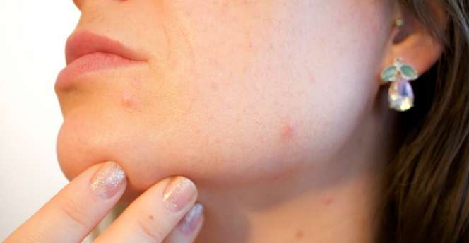 Jerawat Tak Kunjung Sembuh? Ini Mungkin Pemicunya
