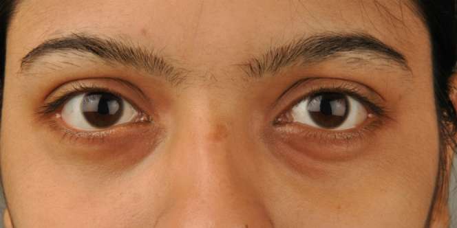 Hilangkan `Mata Panda` Pakai Susu