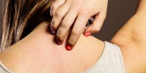 Cara Menghilangkan Panu di Wajah dan Badan dengan Cepat Menggunakan Bahan Alami
