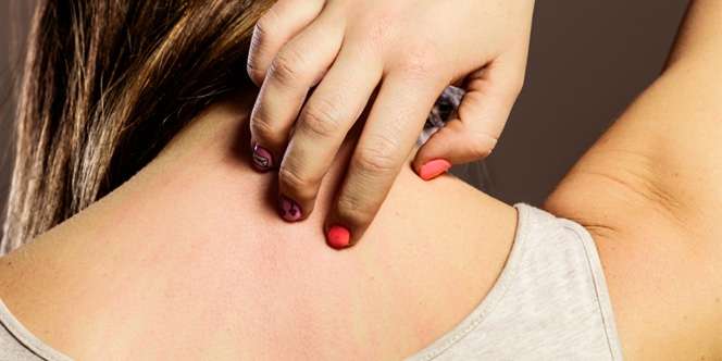 Cara Menghilangkan Panu di Wajah dan Badan dengan Cepat Menggunakan Bahan Alami