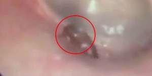 Cek Telinga Karena Sering Nyeri, Si Pria Syok Melihat Penyebabnya