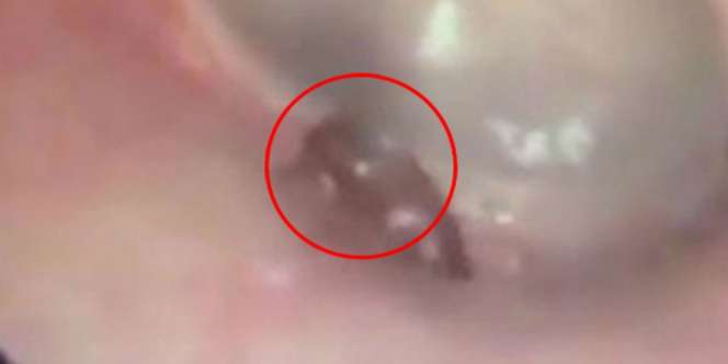 Cek Telinga Karena Sering Nyeri, Si Pria Syok Melihat Penyebabnya