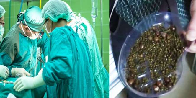 Jarang Sarapan dan Minum Air Putih, Wanita Ini Timbun 2.000 Batu Empedu