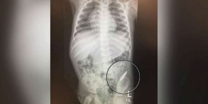 OMG! Sebutir Peluru Tertelan Bocah 3 Tahun