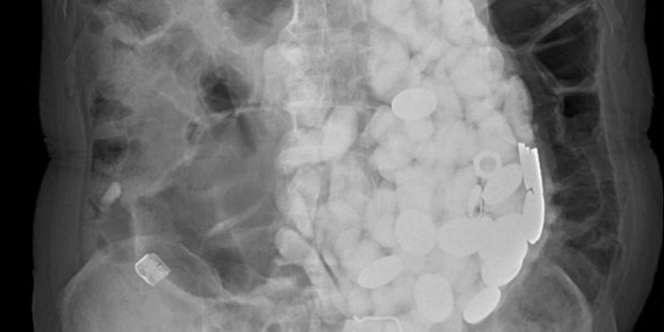 Mengeluh Kembung, Astaga Perut Pria Ini Berisi Batu Hingga Tutup Botol