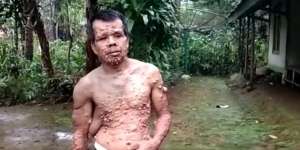 Teten, Si Manusia Kutil dari Sukabumi