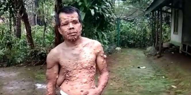 Teten, Si Manusia Kutil dari Sukabumi