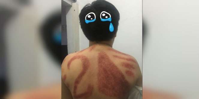 Tukang Urut Ternyata Pendukung Capres, Pria Ini Cuma Pasrah Lihat Hasil Kerokan