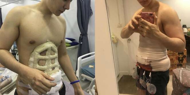 Pria Ini Nekat Oplas Demi Dapatkan Otot Perut Sixpack