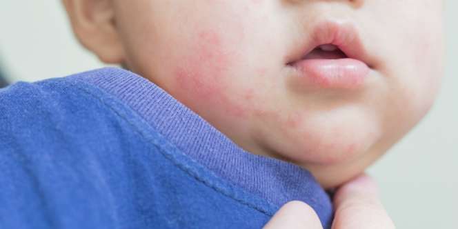 Kulit Pipi Bayi Merah Hingga Melepuh, Cari Tahu Pencetusnya