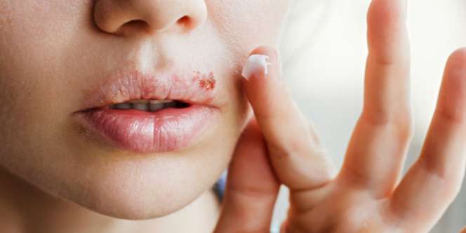 Awas! Virus Herpes Genital Tak Bisa Dibasmi Tuntas