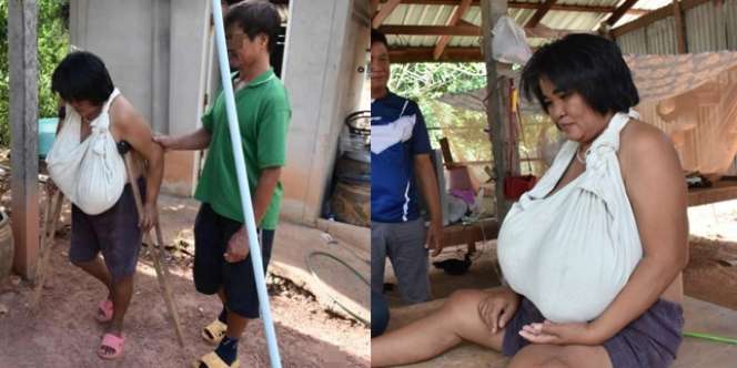 Bukan Kanker, Penyakit Aneh Buat Payudara Wanita Membesar Tak Terkendali