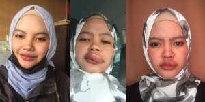 Digigit Serangga, Bibir Gadis Ini Bengkaknya Sebesar Bakpao