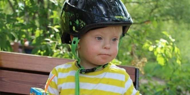 Waspadai Down Syndrome pada Anak, Ini Gejalanya!