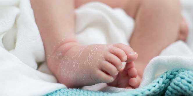 Sindrom Stevens Johnson, Pemicu Kulit Anak Jadi Melepuh