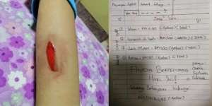 Bermodal Pensil Warna, Bocah 10 Tahun Gambar Luka Seperti Terlihat Nyata