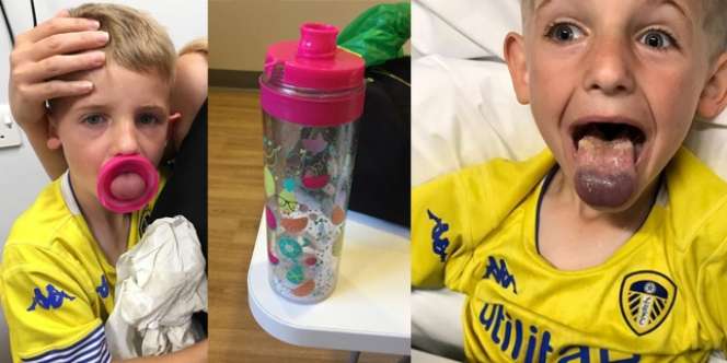 Lidah Terjepit di Tutup Botol Minuman, Bocah Ini Hampir Meninggal