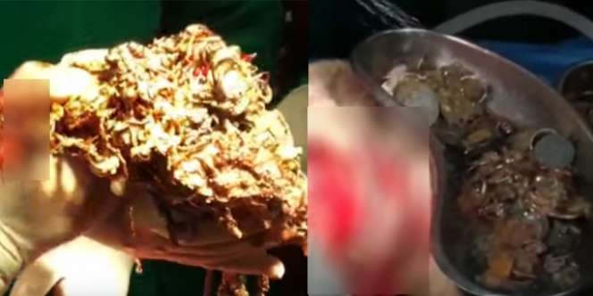Tubuh Mengurus, Astaga! Perut Wanita Ini Berisi Perhiasan Rp1 Miliar