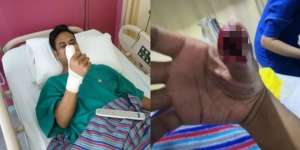 Antigores Gawai Retak, Pria Ini Hampir Kehilangan Jempolnya