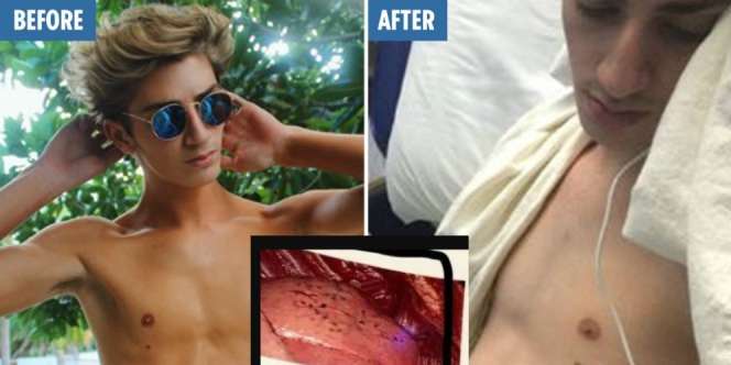 Astaga! Paru-Paru Remaja Ini Hancur karena Isap Rokok Elektrik