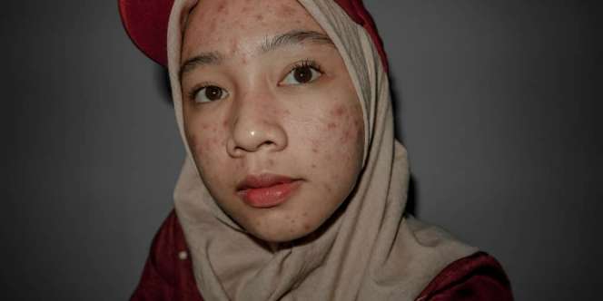 Kisah 'Pejuang Acne' Tetap Pede Lawan Jerawat