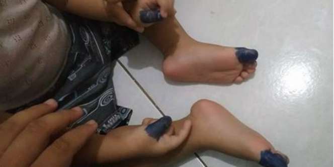 Viral Terapi Sujok Bisa Turunkan Demam Anak, Warganet Mengkritisi