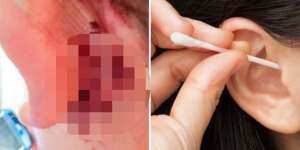 Wanita Ini Nyaris Temui Ajal Gara-Gara Cotton Bud