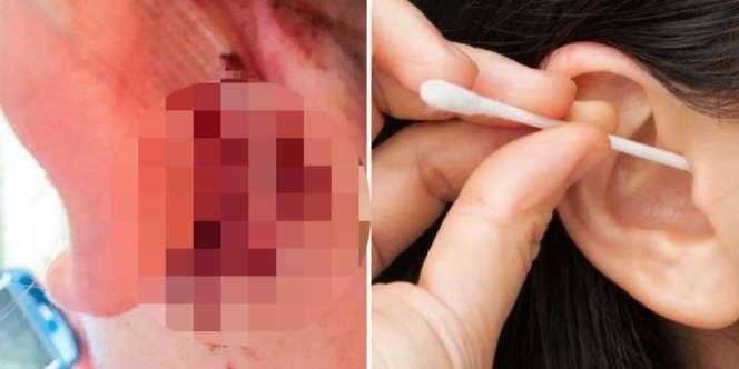 Wanita Ini Nyaris Temui Ajal Gara-Gara Cotton Bud