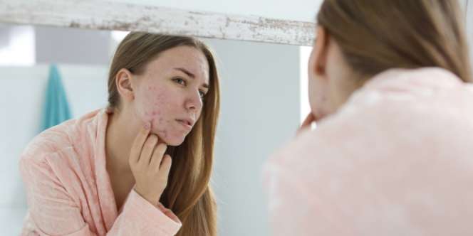 Apakah Acne Patch Efektif Sembuhkan Jerawat?