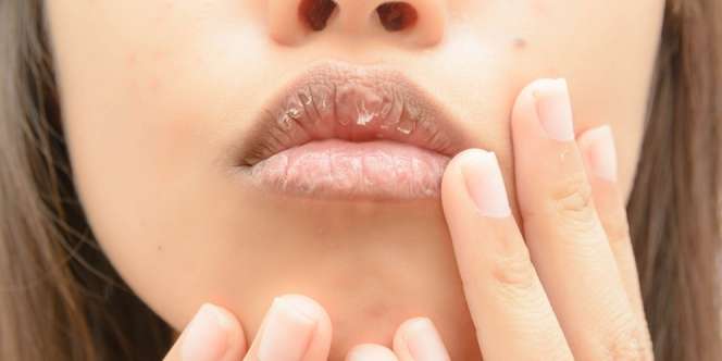 6 Cara Mengatasi Bibir Kering