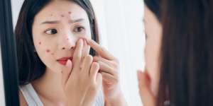 7 Cara Menghilangkan Jerawat secara Alami, Mudah, dan Ampuh