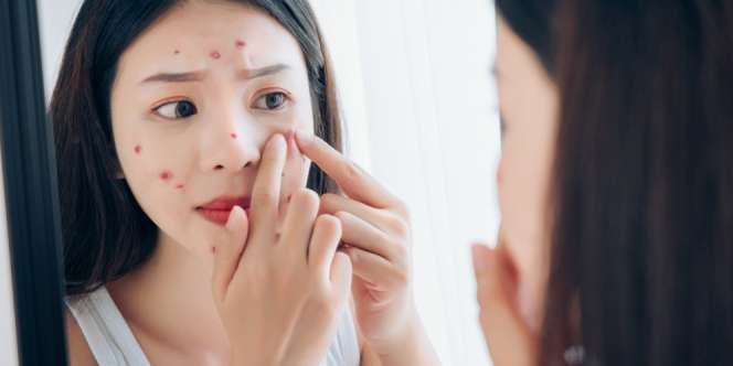 7 Cara Menghilangkan Jerawat secara Alami, Mudah, dan Ampuh