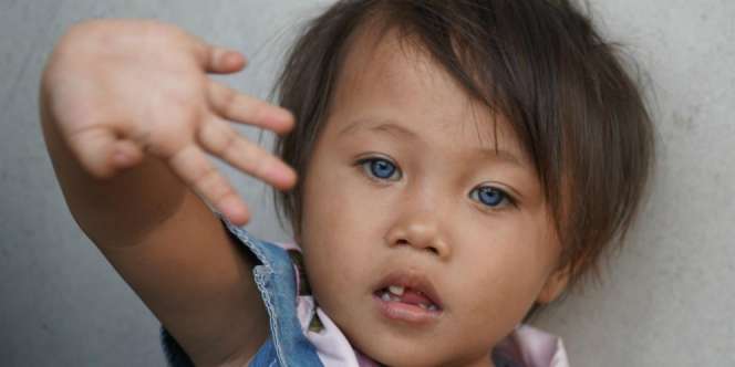 Balita di Bandung Punya Bola Mata 3 Warna, Ini Penjelasan Dokter