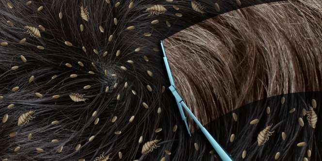 13 Cara Menghilangkan Kutu Rambut, Ampuh dan Efektif