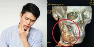 Abaikan Sakit Gigi Selama Setahun, Ternyata Tumbuh Hal Mengerikan!