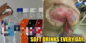 Minum 2 Kaleng Minuman Bersoda Tiap Hari, Tubuh Pria Ini Melepuh