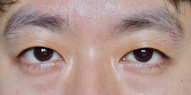 Operasi Mata Gagal, Perempuan di China Tak Bisa Melek