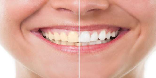 Cara Alami Memutihkan Gigi Dengan Cepat dan Permanen