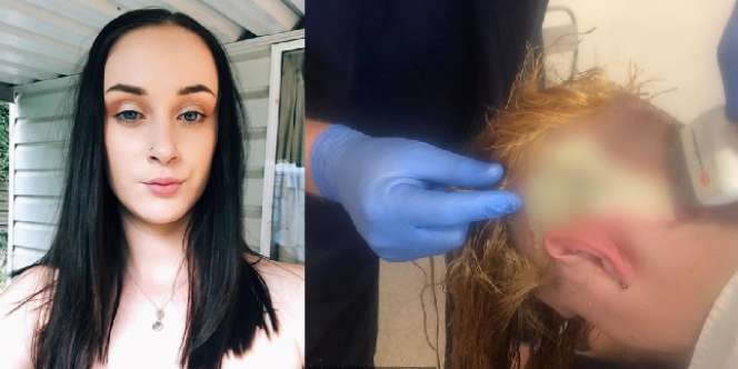 Maunya Hemat dengan Bleaching Sendiri, Kulit Kepala Gadis Ini Malah Terbakar