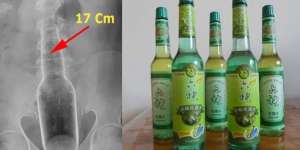 Jangan Ditiru! Pria Ini Garuk Bokong Pakai Botol, Akibatnya..