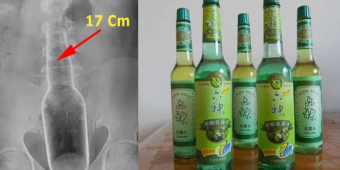 Jangan Ditiru! Pria Ini Garuk Bokong Pakai Botol, Akibatnya..